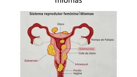 O que é mioma Pediculado?