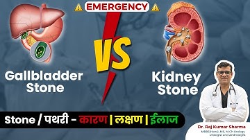 Gallbladder Stone Vs Kidney Stone | SYMPTOMS | TREATMENTS | Dr. Raj Kumar Sharma - Urologist
