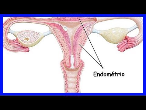 Video: Endometriumhyperplasie - Symptome, Behandlung, Drüsenendometriumhyperplasie