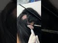 Alopecia areata