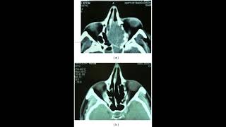 75 Hz : Sinuses, sphenoid (RIFE Healing Frequency)