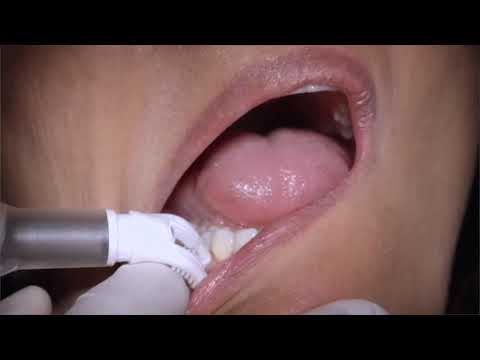 程医生 - 对成人使用 DentalVibe Doctor Ching - Using DentalVibe on Adults