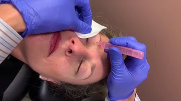 ZEST Procedure with ZocuKit