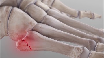 Metatarsal Fractures | Complete Anatomy