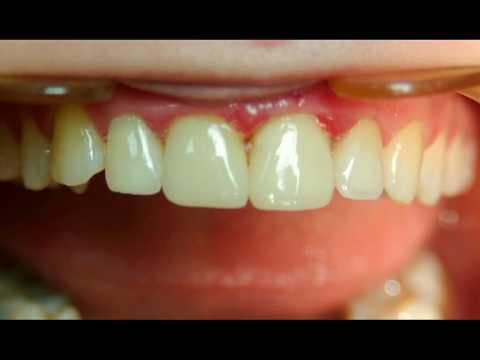 dental composite restoration youtube composite restoration