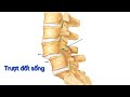 Trượt đốt sống độ 2 có điều trị vật lí trị liệu được không?