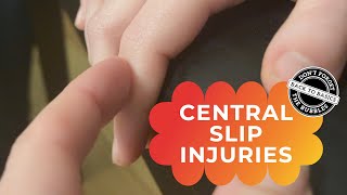 Central slip injuries a Zone 3 finger extensor tendon injury