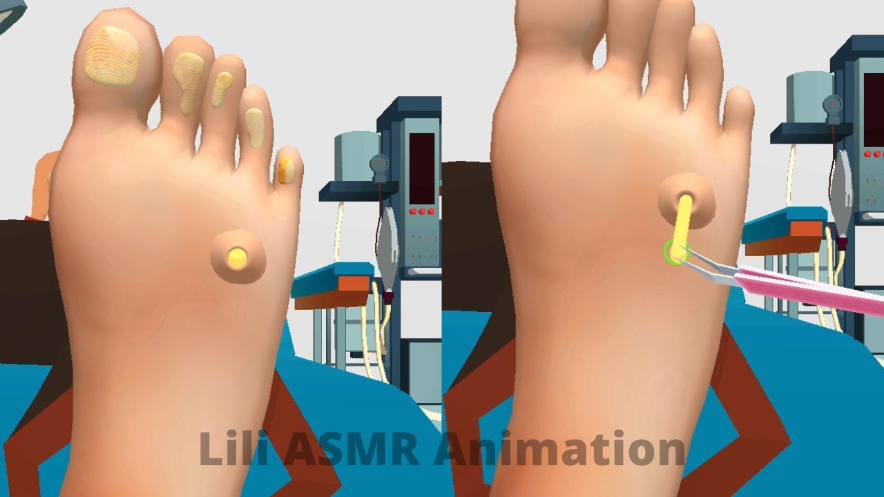 [ASMR] Remove thick dead skin cells ASMR Treatment of severely hard