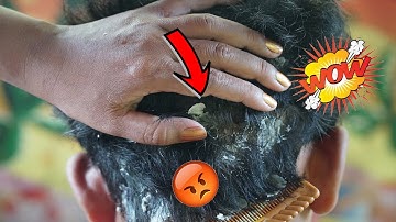 Psoriasis treatment - Big Flakes, Dandruff Scratching #133