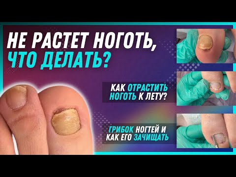 Не растет ноготь, что делать / Как отрастить ноготь к лету? / Грибок ногтей и как его зачищать