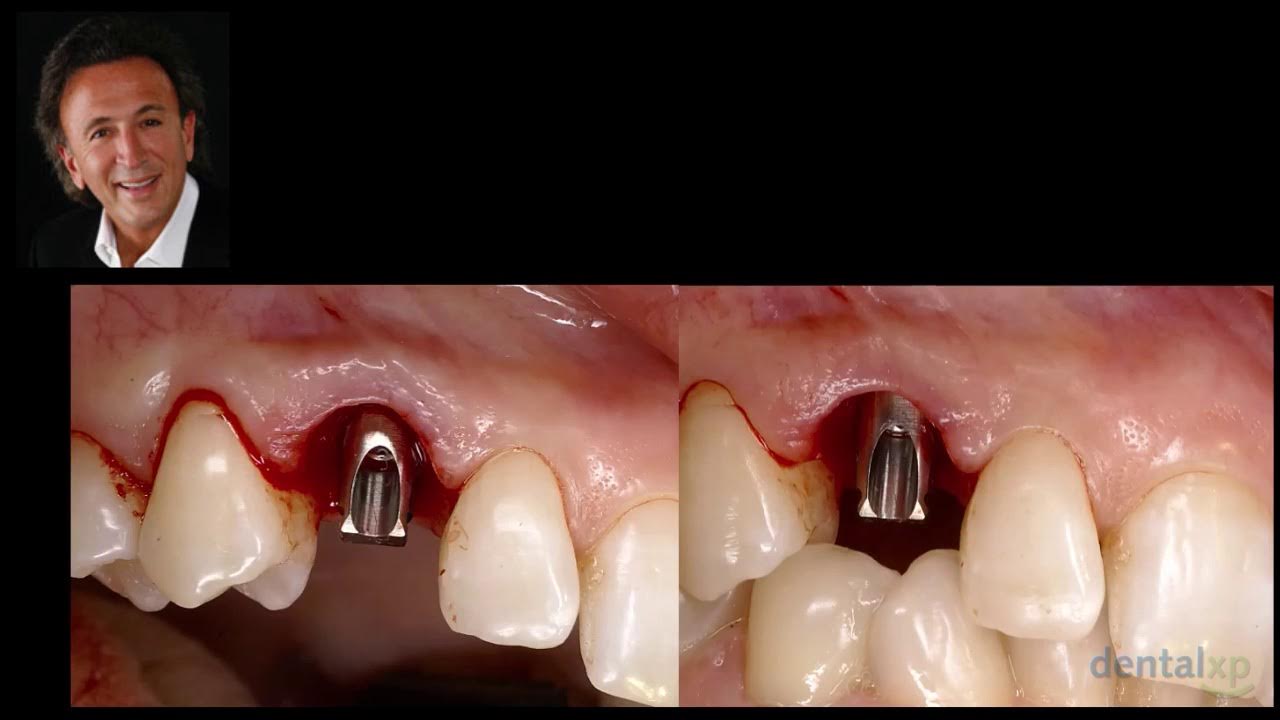 Socket Shield Technique in Immediate Implant Placement YouTube