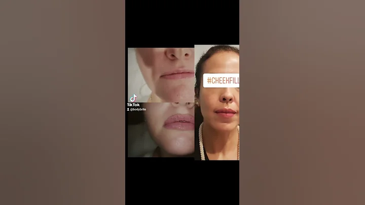 Botulinum toxin A Before and After Photos at BodyBrite Cooper City #botox # xeomin #dysport