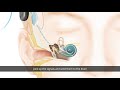 How the Cochlear Nucleus Kanso Implant System Works