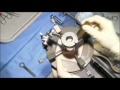 Fresh osteochondral allograft transplantation - dowel technique