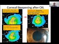 Lecture: Contact Lens Fitting After Corneal Crosslinking for Keratoconus