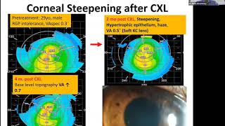 Lecture: Contact Lens Fitting After Corneal Crosslinking for Keratoconus