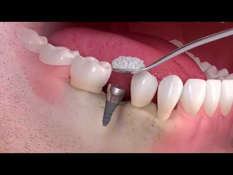 Наращивание кости и имплантация   Straumann®