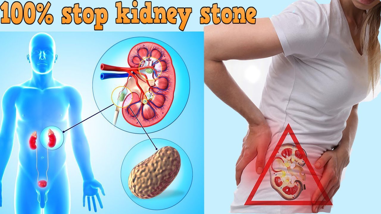Natural Kidney Stone Treatment Tips Home Made Natural Tips For Kidney 