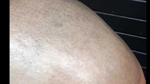 Scalp Micropigmentation at it