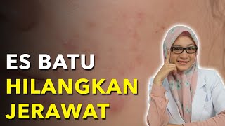 Cara Alami Menghilangkan Jerawat!