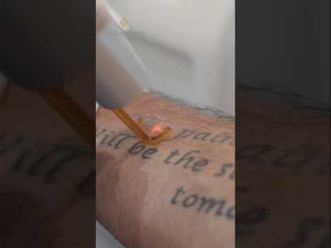 جهاز البيكو وي احدث جهاز تجميلي في العالم لعلاج التصبغات العميقة والسطحية وإزالة التاتو