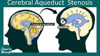 Cerebral aqueduct stenosis | aqueductal stenosis | pathology and treatment | USMLE