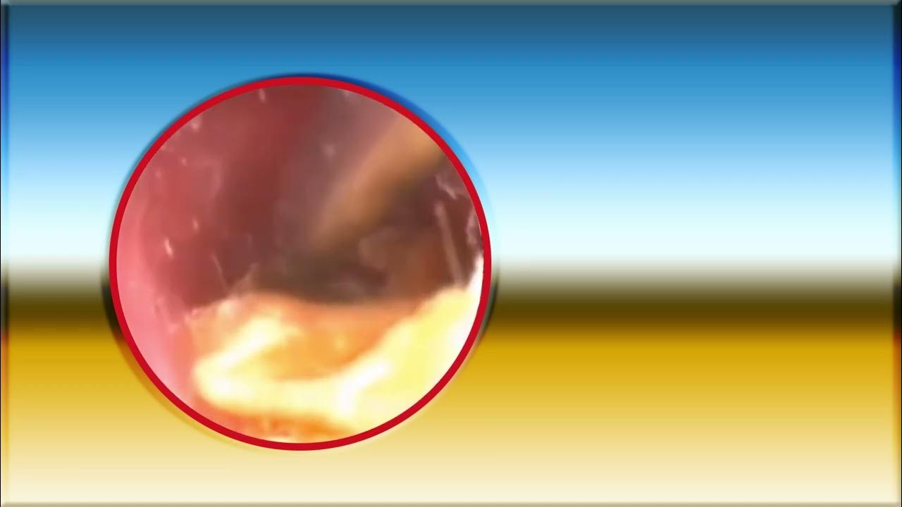 How To removal earwax at home with hydrogen peroxide .ear wax removal