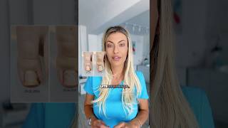 Așa se corectează corect o unghie încarnată #podologie