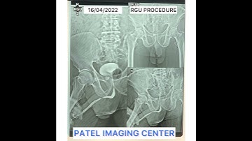 INTERNATIONAL PROCEDURE - RETROGRADE URETHROGRAM (RGU) - PATEL IMAGING CENTER