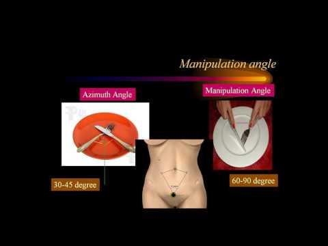 Video Lecture On  Laparoscopic Tissue Approximation By Dr.S.Easwaramoorthy M.S.,FRCS