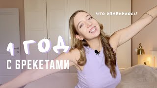 видео: 1 год с брекетами | История моих зубов, часть 3 картинка: 1 год с брекетами | История моих зубов, часть 3
