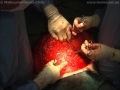Abdominoplasty "Tummy Tuck" & Incisional Hernia Repair Surgery