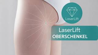 Lipolas® LaserLift Oberschenkel– Hautstraffung einfach erklärt
