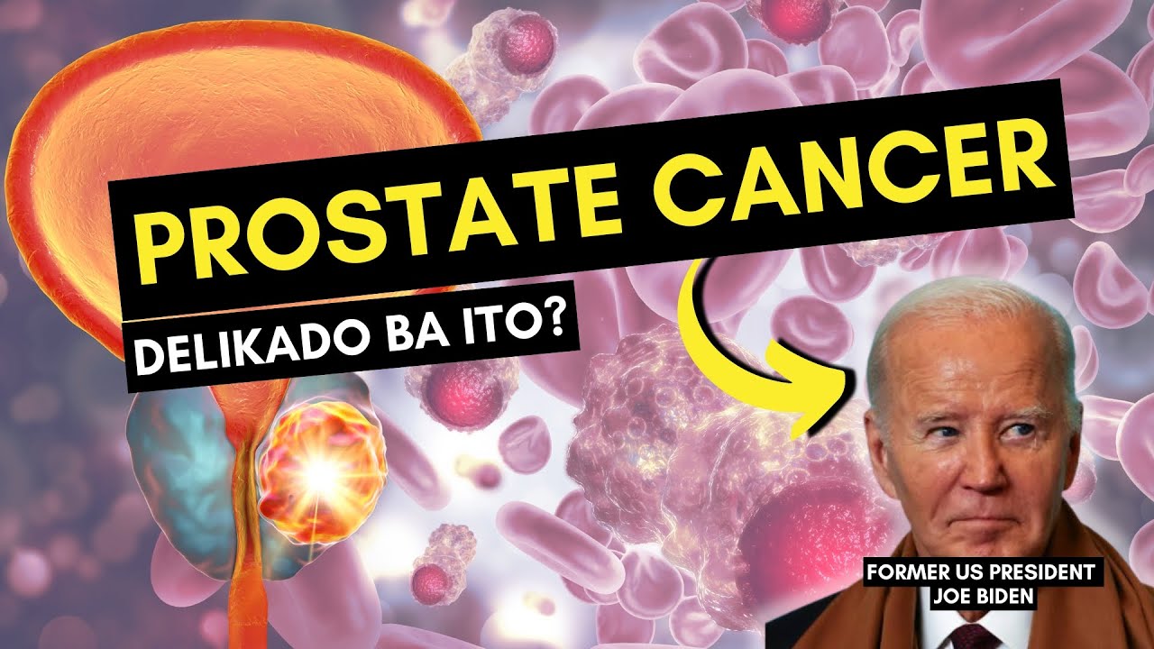 Prostate Cancer: Delikado Ba Ito?