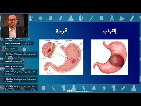 الفرق بين التهاب المعدة وقرحة المعدة والتهاب الاثنى عشر