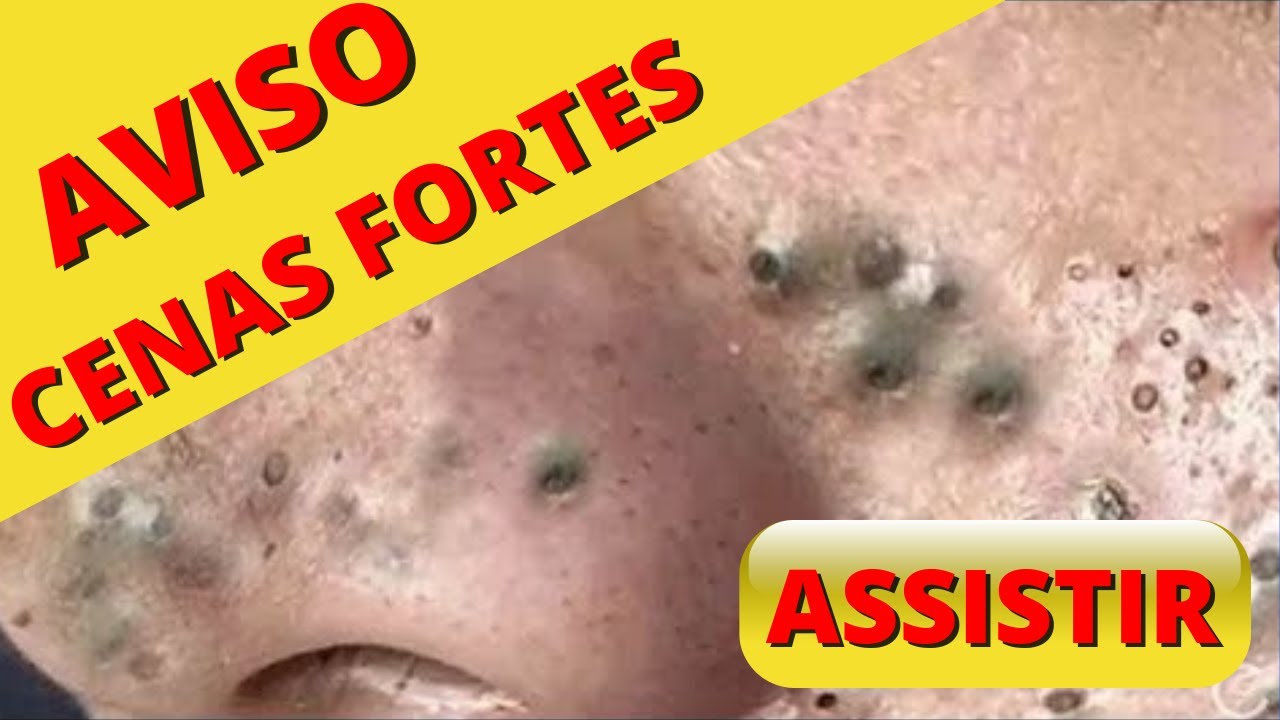 Vídeo Incrível, Espinha Gigante, Espremendo espinha e Cravos , Espinha ...