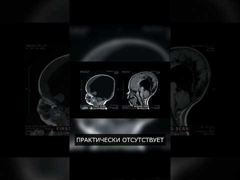 Человек без мозга