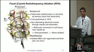 Radiofrequency Ablation RFA for Lumbar Facet Arthropathy   Hisashi Wesley Kobayashi, MD