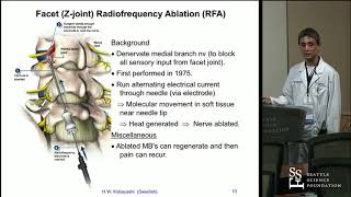 Radiofrequency Ablation RFA for Lumbar Facet Arthropathy  Hisashi Wesley Kobayashi, MD