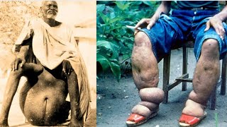 The HORRIFYING History of Elephantiasis
The subject of today’s video is a disease that as many as eight hundred and eighty-two million people are at risk of contracting. It can cause debilitating swelling in the arms, legs and leaving patients with heavy swelling that cause constant pain and discomfort. The HORRIFYING History of Elephantiasis