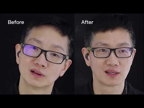 重度四环色牙全瓷贴面美学修复案例