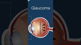 Do you know the difference between Cataracts and Glaucoma? | Nethradhama