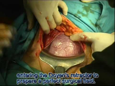 Download C - section - Cesarean delivery in live (Full)
