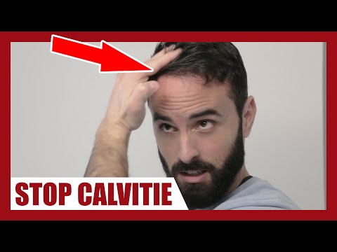 Vidéo: Le Médicament Minoxidil Pour La Calvitie: Mode D'emploi