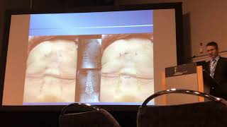 BMI and Obesity Effect on Perioperative Outcome of Trans Kambin OLLIF