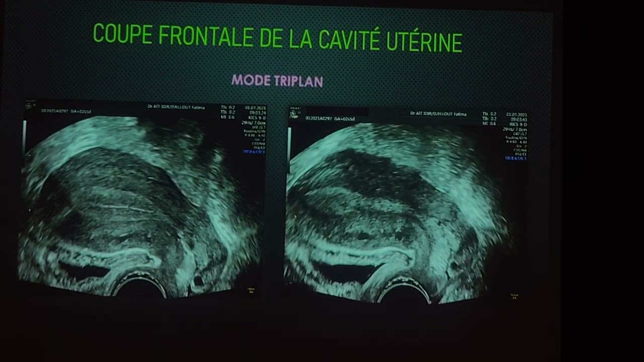 Échographie en pratique gynécologique Dr Ait Idir