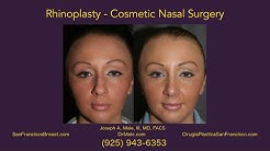 Rhinoplasty San Francisco Bay Area - Nose Job Part 4 of 4