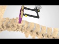 ACDF Patient Education Animation