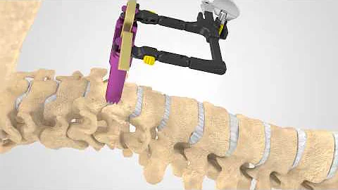 ACDF Patient Education Animation