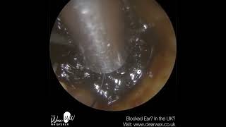1,381 - Last Hope Ear Wax Removal for Patient in a lot of Discomfort